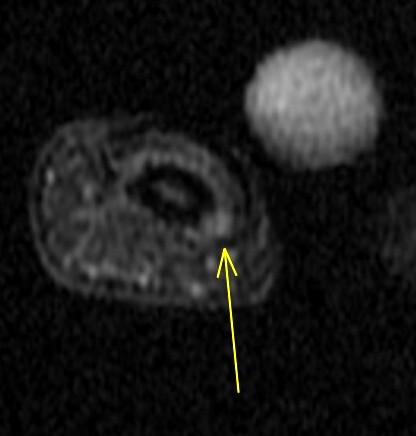 Figure 3 for case glomus tumor ( RID4513 )